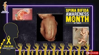 SFM Spina Bifida Awareness Webinar [upl. by Ardnasyl496]