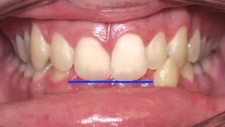 Anterior Crossbite Correction Kyger Orthodontics [upl. by Retsevel735]