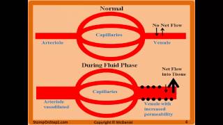 Acute Inflammation Vascular Permeability amp Vasodilation Fluid Phase Macrophage Neutrophil [upl. by Bathelda]