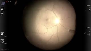 Aphakic 3piece IOL implantation  Fluoroscopic vitrectomy Vista Live Stream [upl. by Edelson612]