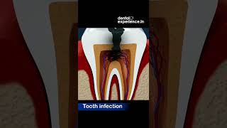 Tooth infection  Abscess  Caries  Symptoms  Treatments  Dentalexperiencein [upl. by Shelah]