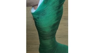 How to Make a Fiberglass PTB Leg Cast Patellar Tendon Bearing Cast [upl. by Leinehtan]