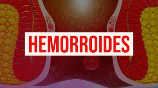 Hemorroides causas diagnóstico síntomas tratamiento y prevención almorranas y sangrado rectal [upl. by Eskill]