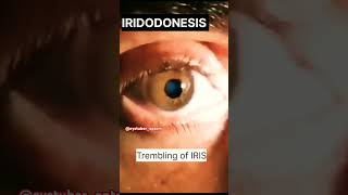 IRIDODONESIS Trembling of IRIS eyetuberoptomeyehealtheyecareshorts [upl. by Hareehahs439]