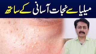 Milia causes symptoms and treatment  Dr Faisal Syed [upl. by Adnohsad]