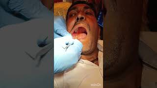 Lower mandibular molar extraction [upl. by Joell]