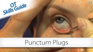 OT skills guide punctum plugs [upl. by Aidyn]