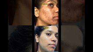 Tretinoin transformation before and after tretinoin tretinoincream shortsfeed face pimple [upl. by Ecilahs]