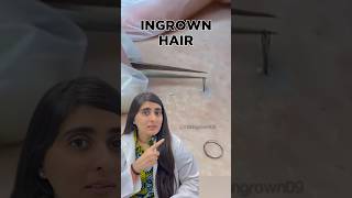 Ingrown Hair Removal  Ingrown Hair Treatment  Ingrown Hair Dermatologist [upl. by Anerhs]