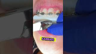 Anxious about getting your braces off  Toothtime New Braunfels Texas dentalbraces braces [upl. by Inava]