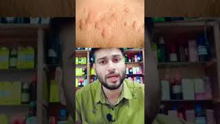 Urticaria पित्ती उछलना ठिक करने की रामबाण होम्योपैथिक दवा REPL 181 DROP urticaria urticariarelief [upl. by Edgardo185]