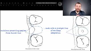 7a The “S” Roll Flap Technique [upl. by Ryle]