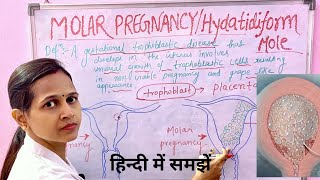 Molar Pregnancy Hydatidiform MoleImportant for all nursing examsअसमान्य गर्भावस्था [upl. by Barbra]