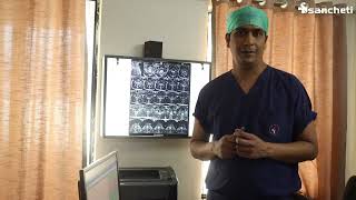 Cervical spine disc replacement surgery Sanchetispinepune [upl. by Ollehcram]