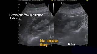 Persistent fetal lobulation kidney ultrasound video [upl. by Yllib]