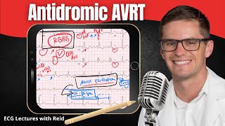 Antidromic AV Reentry Tachycardia AVRT EKG  ECG Lecture [upl. by Bazluke457]