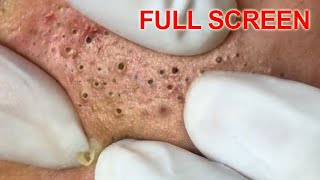 Blackheads removal  Best Pimple Popping Videos [upl. by Inwat]