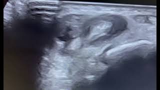 Ultrasound of tenosynovitis  wrist joint [upl. by Cloots]