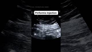 Piriformis Injection ultrasound guided [upl. by Orutra]