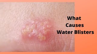 What Causes Water Blisters [upl. by Ondine]