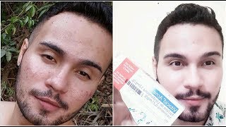 VITACID ACNE  COMO ACABAR COM AS ESPINHAS E MACHAS  Jhunior Hemebrt [upl. by Doug]