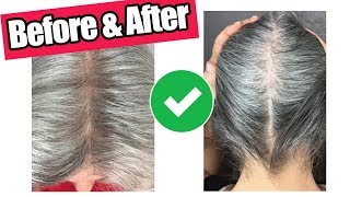 ✅ HONEST iRestore Laser Hair Growth System Review 🔥 6 Months Before and After [upl. by Staley]