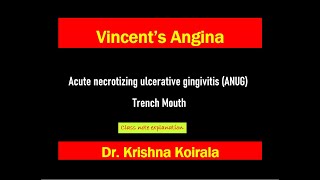 Vincents angina Acute Necrotizing Ulcerative Gingivitis ANUGTrench Mouth Slide Explanation [upl. by Strohbehn]