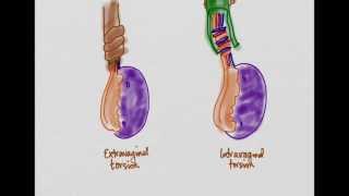 Testicular Torsion [upl. by Eveiveneg]