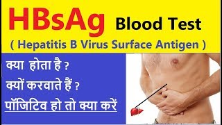 HbsAg test in hindi  HBsAg टेस्ट पॉजिटिव हो तो क्या करें  HbsAg test क्या होता है I क्यों कराते है [upl. by Eidissac]