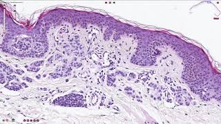 Compound Melanocytic Nevus  Histopathology [upl. by Ayikan604]