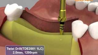 HIOSSEN OSSTEM GSIII GS HG System surgical procedures [upl. by Ainekahs]