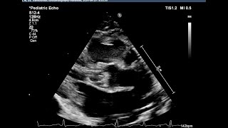 Basic echocardiography심장 초음파 기본 Bicuspid aortic valve dysplastic aortic valve [upl. by Asseneg811]