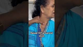 Raised JVP and Carotid thrill medicine biology mbbs neetpg [upl. by Anrahs495]