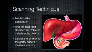 pyloric stenosis [upl. by Ozner]