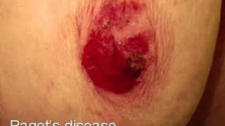 DermTV  Pagets Disease of the Breast DermTVcom 347 [upl. by Anneg]