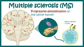 Multiple sclerosis  Types of Multiple Sclerosis  Causes symptoms diagnosis treatment pathology [upl. by Greene]