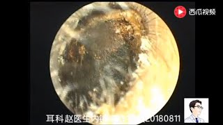 Ear endoscope cleaning the external auditory canal and answering common questions [upl. by Solomon919]