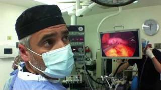 OCC Importance of Gastric Sleeve Leak Test [upl. by Anidam]