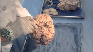 Orientation The Planes of the Brain Neuroanatomy Video Lab  Brain Dissections [upl. by Novihc]