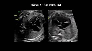 2023 Fetal Echocardiography Normal and Abnormal Hearts  A Video CME Teaching Activity [upl. by Anihsak]