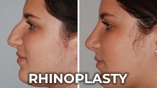 Transforming the Nose A Comprehensive Guide to Rhinoplasty [upl. by Alag667]