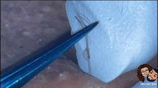 Ingrown Hair Removal Ep28 [upl. by Ravahs]