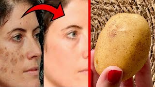 How I Wiped off Facial Blemishes with Potatoes in 20 Minutes  Skin Like Porcelain [upl. by Matheny]