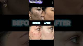 Treatment For Hyperpigmentation amp Melasma [upl. by Eiramyelhsa708]