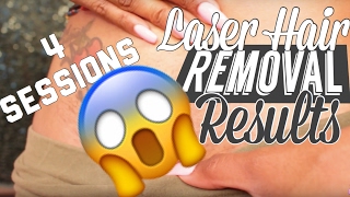 Bikini Laser Hair Removal  Visual Results after FOUR sessions [upl. by Olraced]