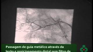 Angioplastia de Artéria Renal [upl. by Demakis239]