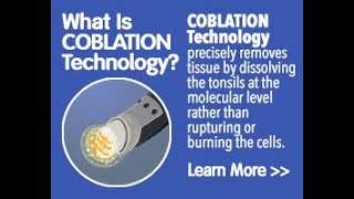 Coblation assisted adenoidectomy [upl. by Callean]