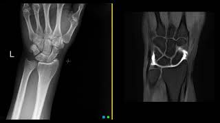 What is an MRI wrist arthrogram [upl. by Margalit]