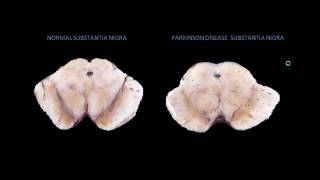 Parkinson Disease Pathophysiology Animation [upl. by Kotick]