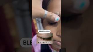 Eye infection blepharitis shortsfeed youtubeshorts shortvideo shorts [upl. by Heigho586]